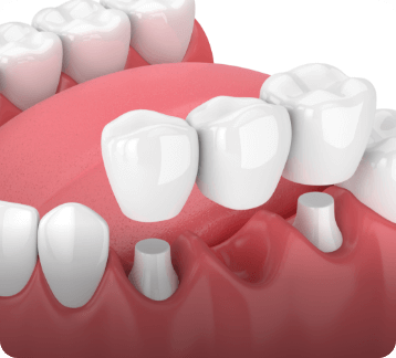 Dental Bridges | Donsdale Dental | West Edmonton | Family and General Dentist