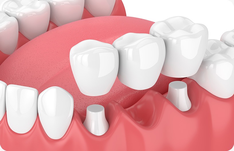 Dental Bridges | Donsdale Dental | West Edmonton | Family and General Dentist
