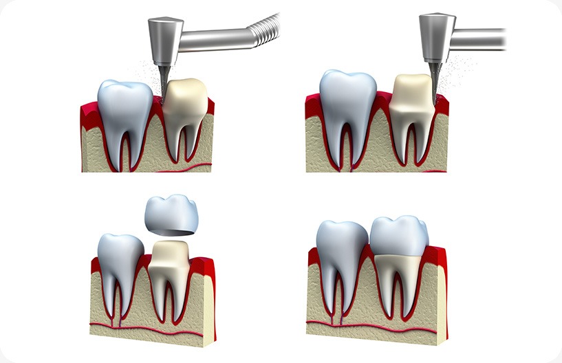 Dental Crowns | Donsdale Dental | West Edmonton | Family and General Dentist