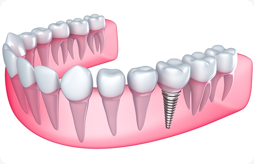 Dental Implants | Donsdale Dental | West Edmonton | Family and General Dentist