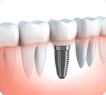 Dental Implants | Donsdale Dental | West Edmonton | Family and General Dentist