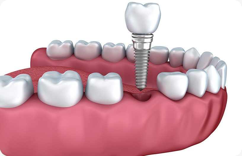 Dental Implants | Donsdale Dental | West Edmonton | Family and General Dentist