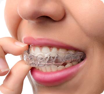 Invisalign | Donsdale Dental | West Edmonton | Family and General Dentist