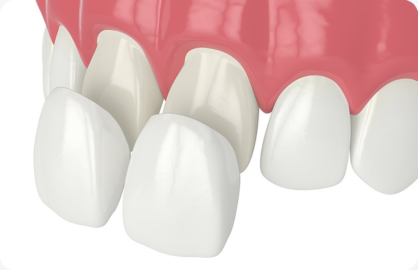 Porcelain Veneers | Donsdale Dental | West Edmonton | Family and General Dentist