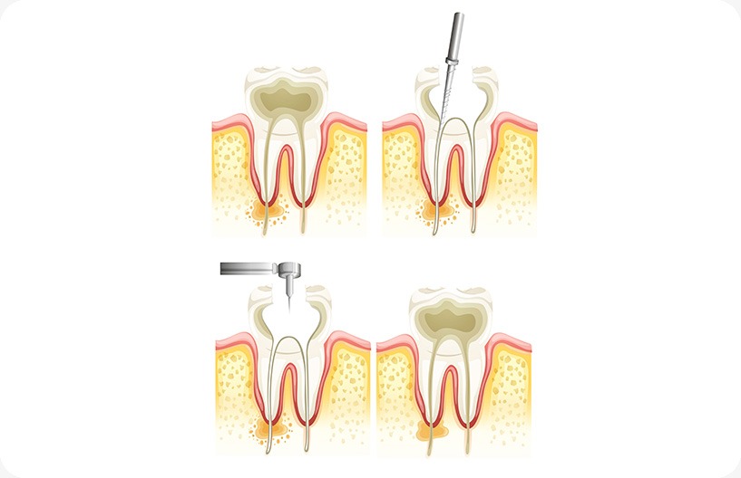 Root Canal Therapy | Donsdale Dental | West Edmonton | Family and General Dentist