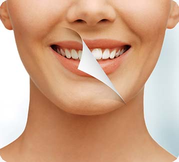Teeth Whitening | Donsdale Dental | West Edmonton | Family and General Dentist