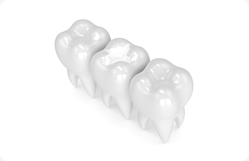 White Fillings | Donsdale Dental | West Edmonton | Family and General Dentist