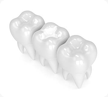 White Fillings | Donsdale Dental | West Edmonton | Family and General Dentist